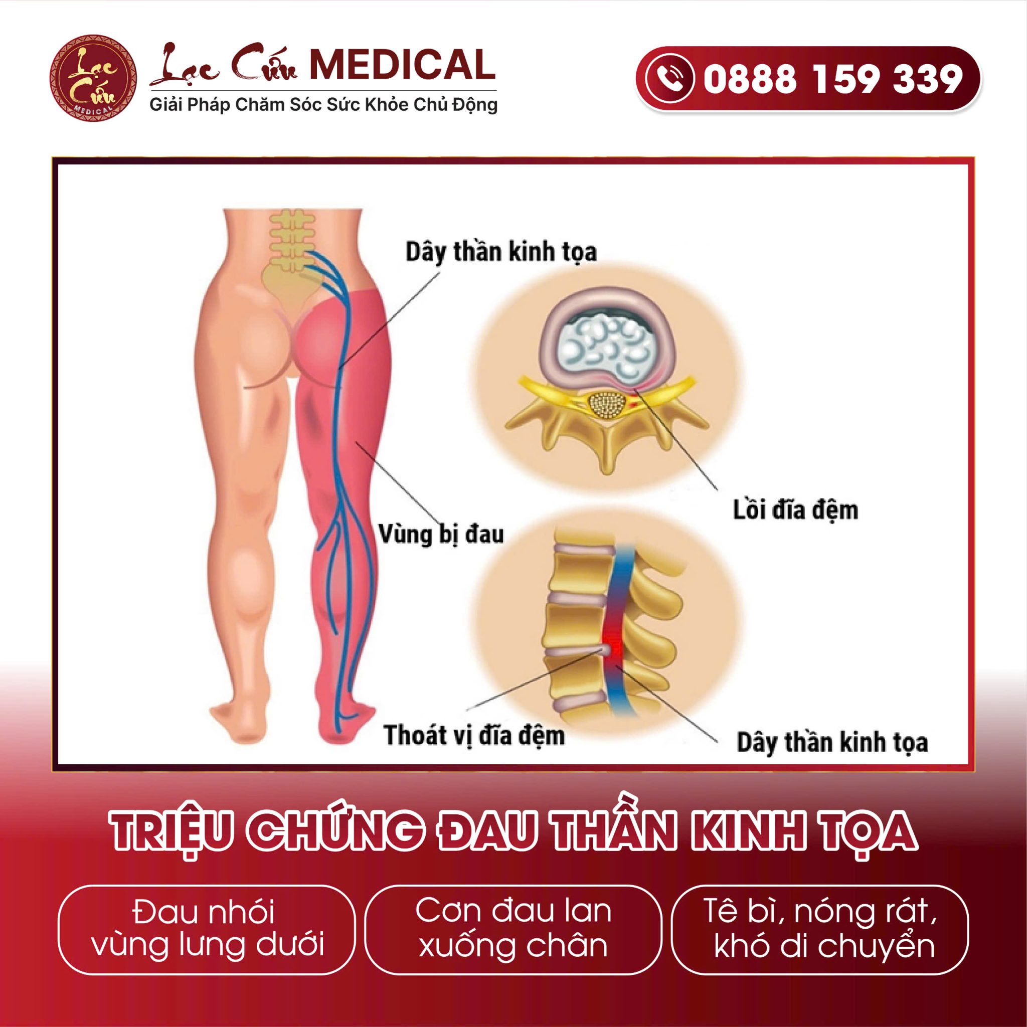 Đau Thần Kinh Tọa Là Gì?