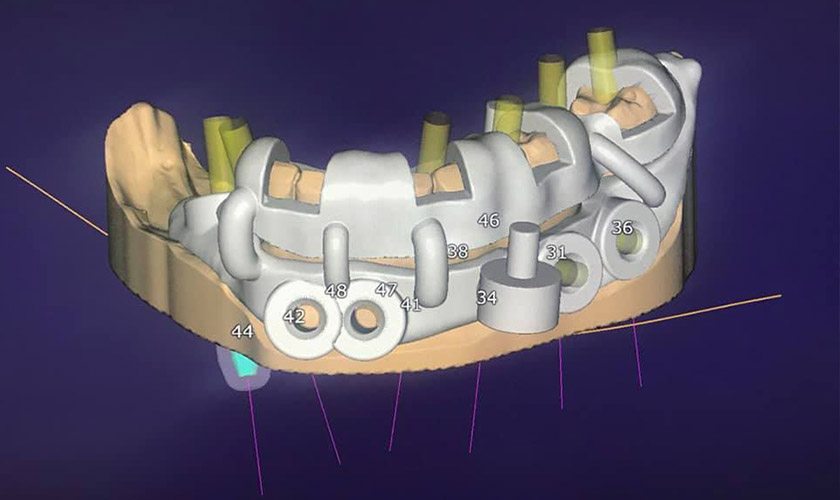 Máng hướng dẫn cấy ghép implant nhiều tầng