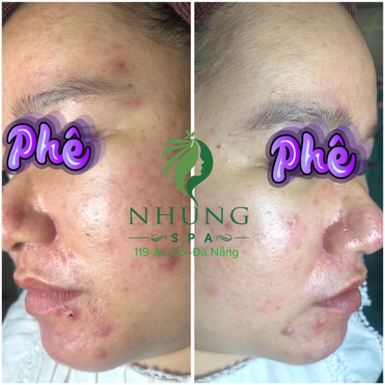 2. Trị Mụn, Nám và Tàn Nhang Đà Nẵng