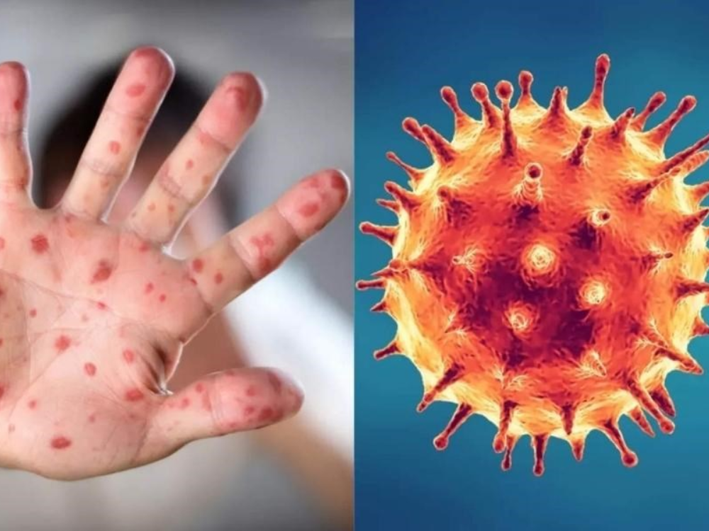 Phòng tránh bệnh Đậu mùa khỉ