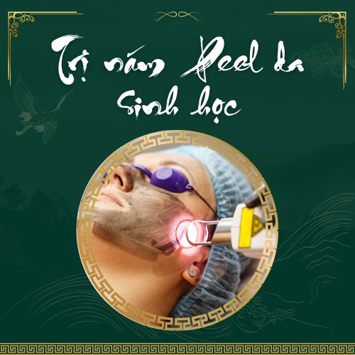 Điều trị nám bằng laser phù hợp với loại nám nào?