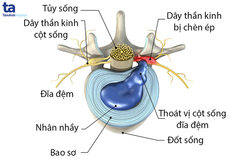 Yếu Sinh Lý Có Phải Do Thoát Vị Đĩa Đệm