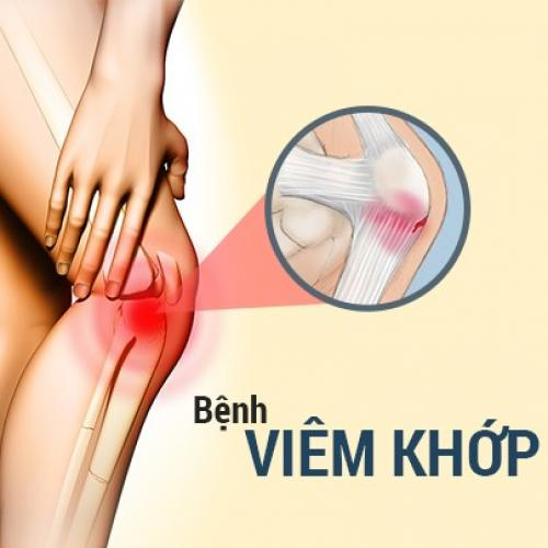 Bệnh Lý Viêm Xương Khớp: Nguyên Nhân, Dấu Hiệu, Cách Chữa